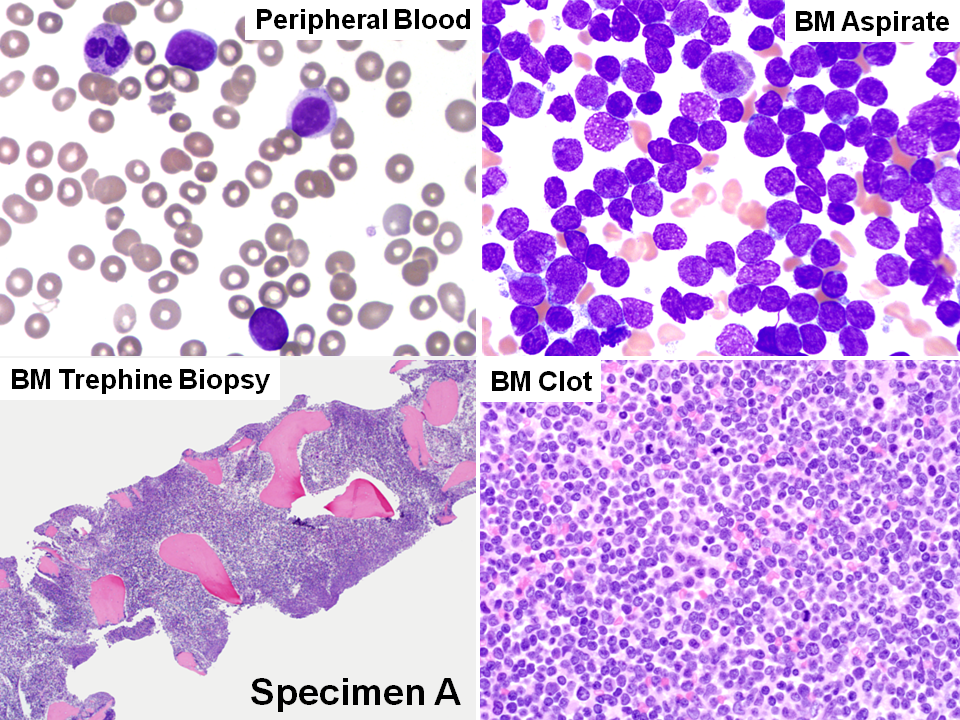 Peripheral blood and bone marrow, at diagnosis (A)